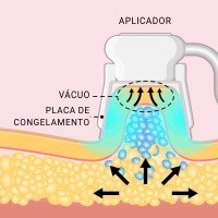 aurya_criolipolise_02_compressor